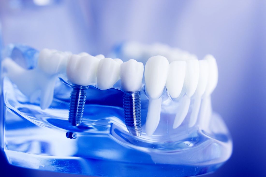 Статья Имплантация в стоматологии
